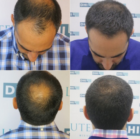 Direct-Hair-Implantation(DHI)-Doğrudan-Sas-Ekimi-oncesi-sonrasi-resimleri