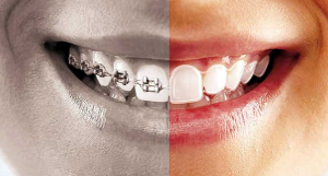 Görünmeyen Diş Teli Uygulaması (Lingual Ortodonti) Yöntemi