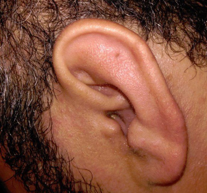 orta-kulak-iltihabı-belirtisi