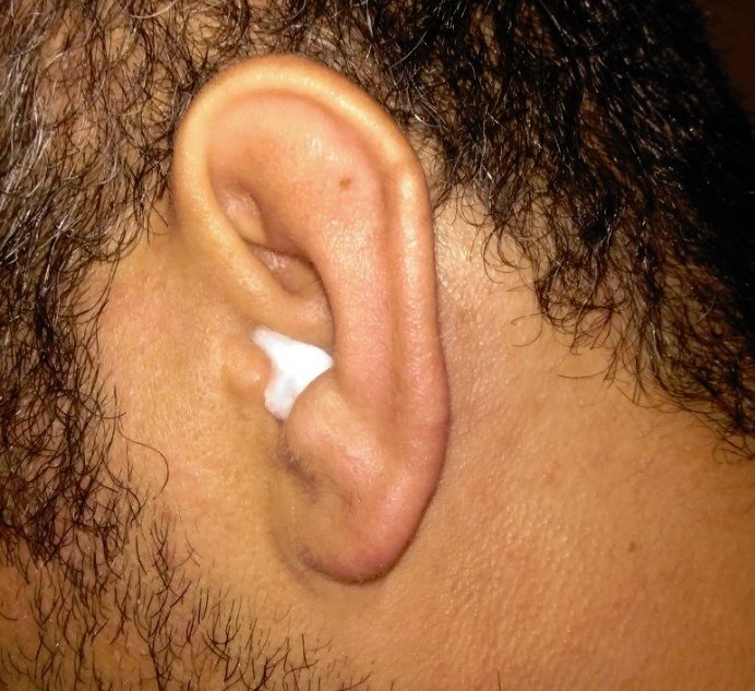 orta-kulak-iltihabı-tedavisi