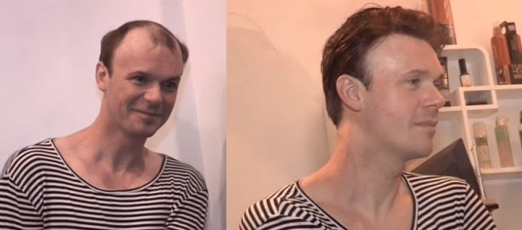 Protez Sac Fiyatlari 2021 Ve Protez Sac Sonrasi Bakim Ucretleri Dogru Ve Guncel Hayattan Haberler Protez Sac Fiyatlari 2021 Ve Protez Sac Sonrasi Bakim Ucretleri Dogru Ve Guncel Hayattan Haberler