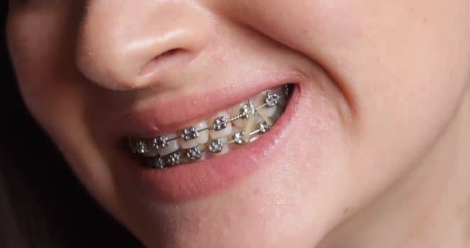 Diş Teli Fiyatları 2023 (Metal , Görünmez , Şeffaf Diş Teli ve Şeffaf Plak Çeşitleri)