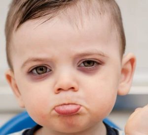 Bebeklerde Göz Altında Morluk Neden Olur? Tehlikeli mi?